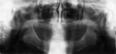 Panoramic radiographic image in an edentulous pati