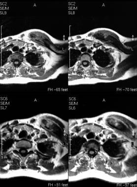 Osteomyelitis, chronic. T1-weighted nonenhanced (t