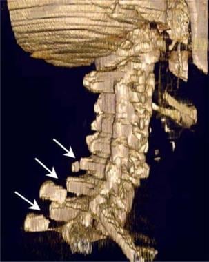 Thoracic spine trauma. Three-dimensional surface C