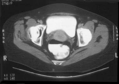 CT of clinical stage IIB cervical carcinoma. The p