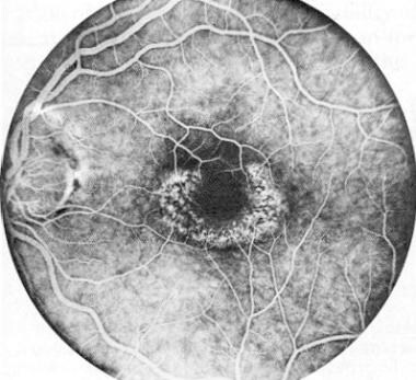 Fluorescein angiogram of left macula in patient wi