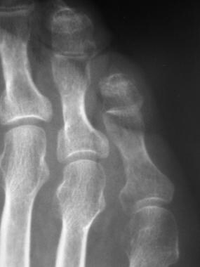 Fifth-toe deformities. This radiograph shows promi