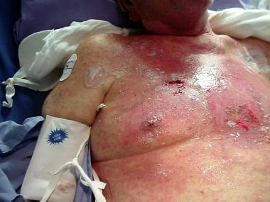Case A. Cutaneous injury caused by irradiation of 