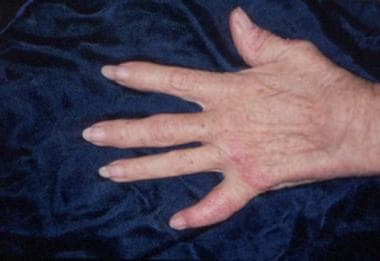 Psoriatic arthritis involving the distal phalangea