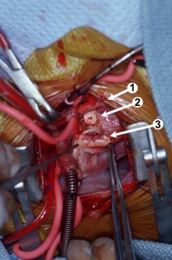 Intraoperative photograph. (1) The divided distal
