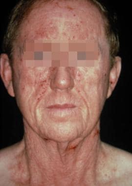 Airborne contact dermatitis in a patient who is al