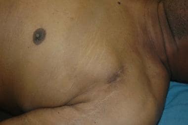 The chest of an individual who died from severe un