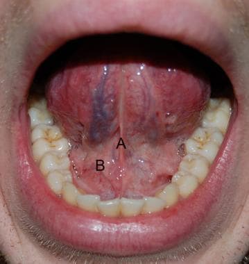Black Lesion In Mouth 16
