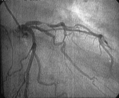 Perioperative cardiac management. Coronary angiogr