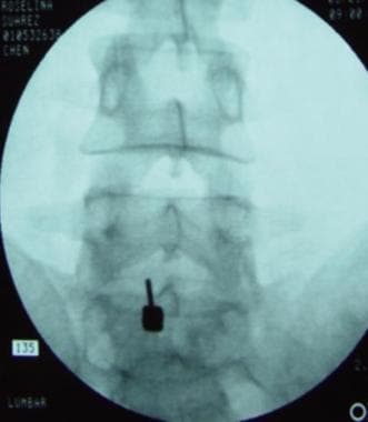 Caudal epidural steroid injection with fluoroscopy