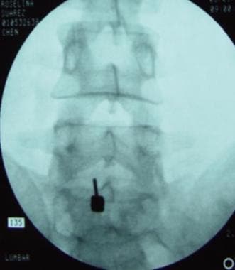 Interlaminar approach at the L5-S1 level on the le