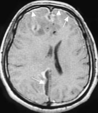 Frontal sinusitis, empyema, and abscess formation 