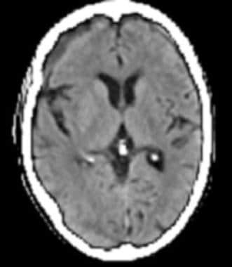 Late subacute subdural hematoma has decreased atte