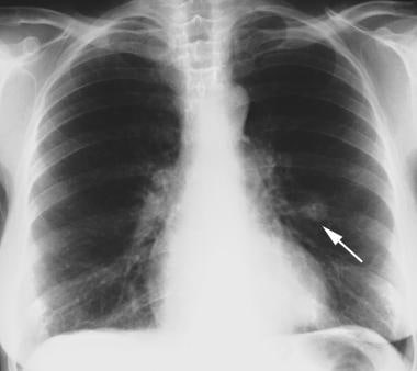 Posteroanterior (PA) chest radiograph shows an inc