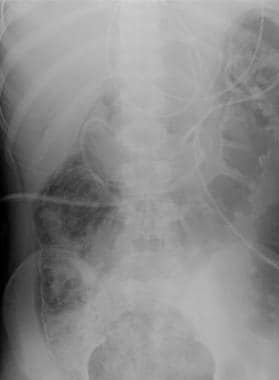 Mesenteric ischemia. Plain abdominal radiograph in