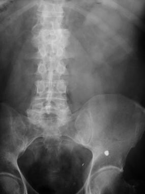 Urinary Calculi Imaging: Overview, Radiography, Computed Tomography