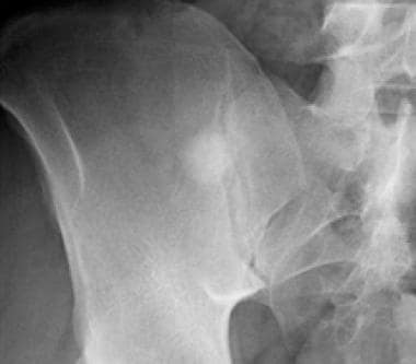 Plain film radiograph of the pelvis. A sclerotic f
