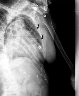 This detailed oblique radiograph shows 2 rib fract