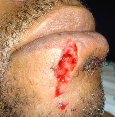 Lip laceration involving the lower vermilion borde