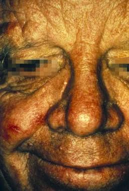 A patient with trichilemmoma papules on the face. 