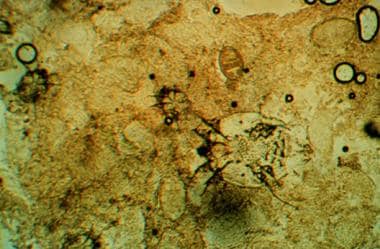 Scabies preparation demonstrating a mite and ova. 