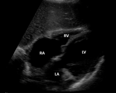 Ultrasound image of subxiphoid 4-chamber view