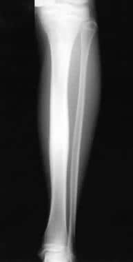 Anteroposterior radiograph of the left tibia. This