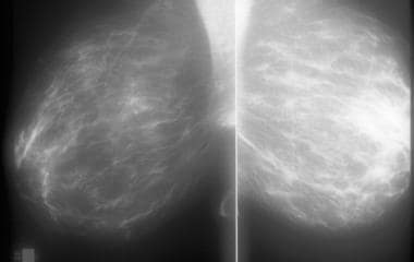 Mammographic appearance of breast hypertrophy with