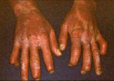 Psoriatic arthritis involving the distal phalangea
