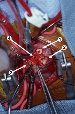 Intraoperative photograph. (1) The left coronary a