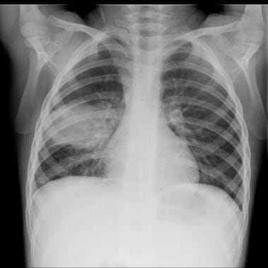 Pediatric Pneumonia: Practice Essentials, Background, Pathophysiology