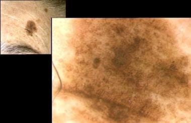 Malignant melanoma in situ on face or lentigo mali