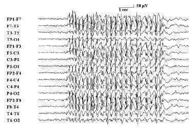 Electroencephalogram demonstrating absence epileps