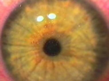Immediate postoperative image of the eye that show