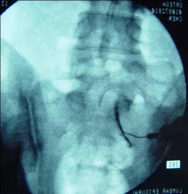 Transforaminal approach at the S1 level on the rig