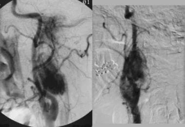 Multiple glomus tumors. Angiogram obtained in a fe