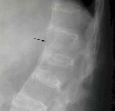 Thoracolumbar junction fracture. Lateral radiograp