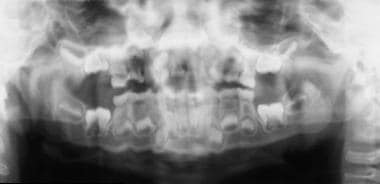 Panoramic radiographic image in a 5-year-old boy. 
