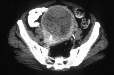 A 63-year-old woman with moderately differentiated