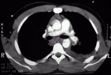 Contrast-enhanced CT of acute traumatic aortic inj