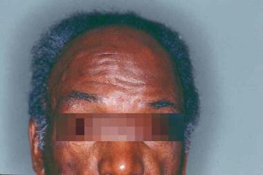 Multiple epidermoid cysts on the forehead of a pat