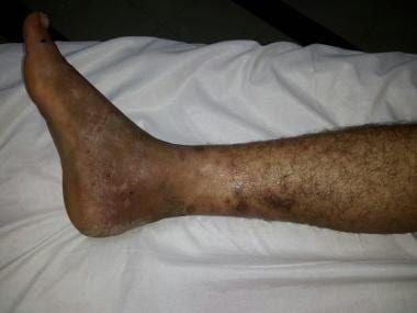 Superficial thrombophlebitis in a Behçet disease p