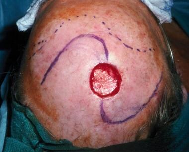 A scalp defect following excision of a leiomyosarc