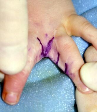 Hand of 26-month-old patient who underwent release