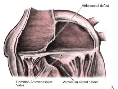 Endocardial Cushion Defects (Atrioventricular Cana
