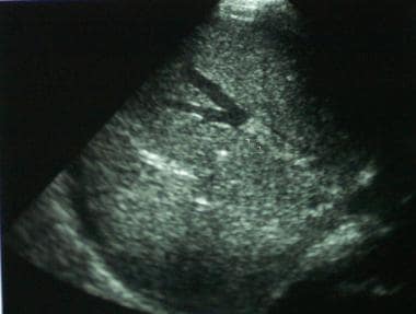 Sonogram showing hepatic vein thrombus. 