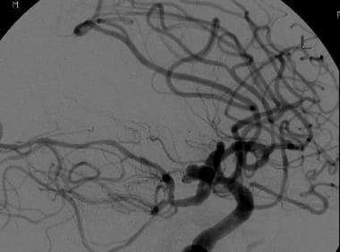 Computed tomographic angiography examination and s
