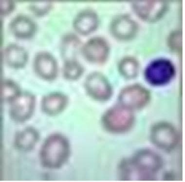 Megaloblastic anemia. View of red blood cells 
