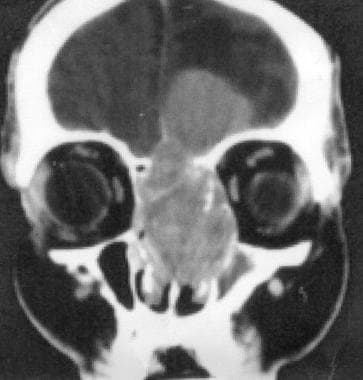 Esthesioneuroblastoma. Coronal CT scan of the orbi