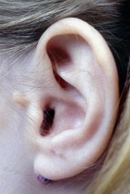 Preauricular ear tag. Image courtesy of Jack Yu, M